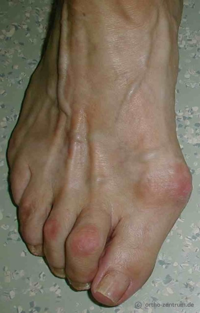 Valgus-Fehlstellung Valgus-Fehlstellung