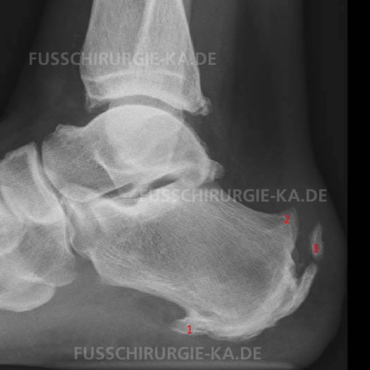 Röntgenbild Fersensporn - Fasciitis plantaris