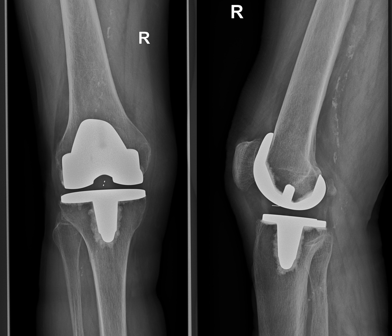 Röntgenbild einer Knieendoprothese